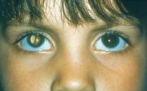 Катаракта глаза - что это такое: симптомы и лечение Как проявляет себя катаракта глаза