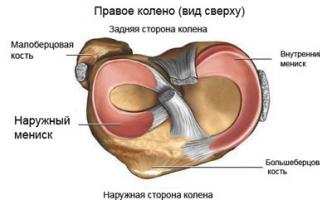 Повреждение наружного мениска коленного сустава