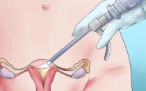 O que é limpeza em ginecologia?