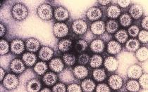 Infecção por rotavírus Infecção por rotavírus em uma criança