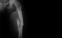 Diafyzárne zlomeniny stehennej kosti Prognóza diafyzárnych zlomenín holennej kosti