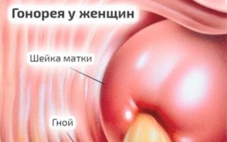 Kişilərdə gonoreya simptomları, müalicəsi və qarşısının alınması