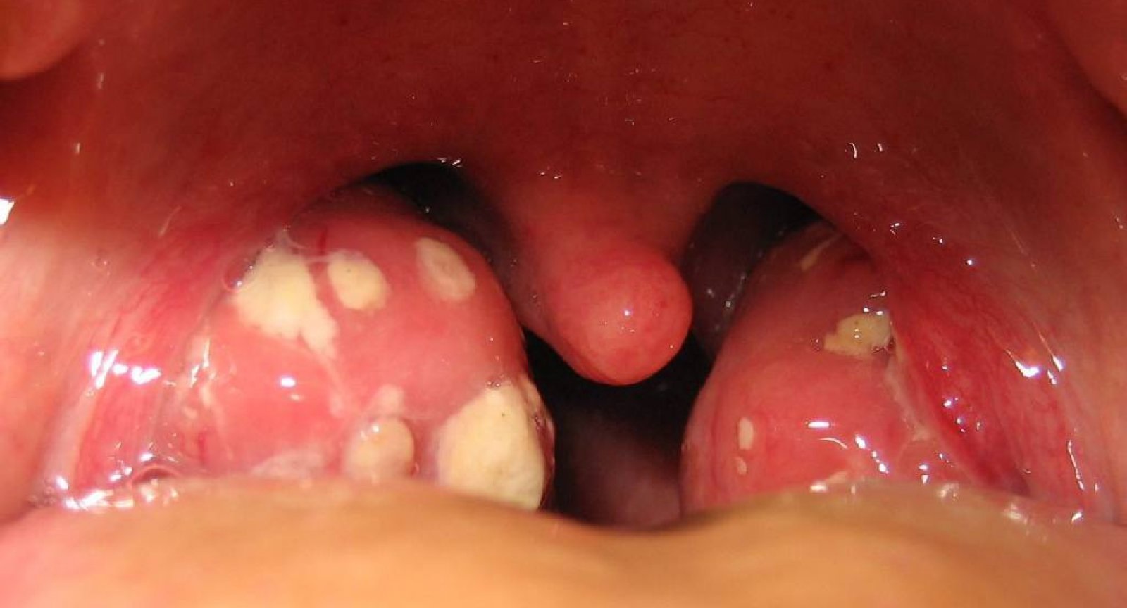 Болит горло сводит челюсти