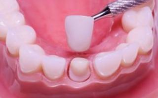 Metódy liečby zubného kazu a príčiny jeho výskytu