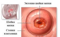Patologias cervicais: doenças comuns, suas fotos, sintomas e sinais Tratamento de doenças cervicais
