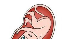 Ponction du sac amniotique : un caprice des médecins ou une opération pour sauver une vie ?