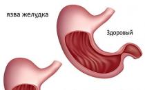 Виразка шлунка - симптоми та ознаки прояву у дорослих, лікування, дієта та профілактика виразкової хвороби