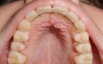 Przyczyny bólu podniebienia w jamie ustnej i jego leczenie