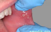 Leczenie zapalenia jamy ustnej środkami ludowymi Nalewka z nagietka do stosowania na zapalenie jamy ustnej