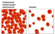 Iron deficiency anemia (IDA)