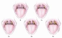 Niyə uşaq yuxuda dişlərini sıxır: uşaqlarda diş qıcırtısının səbəbləri Niyə uşaqlar yuxuda dişlərini üyüdür